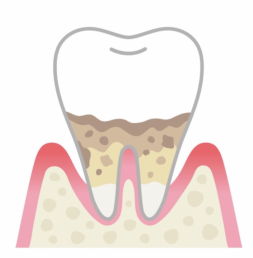 歯周病イメージ